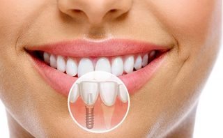 Имплантация зубов: этапы проведения