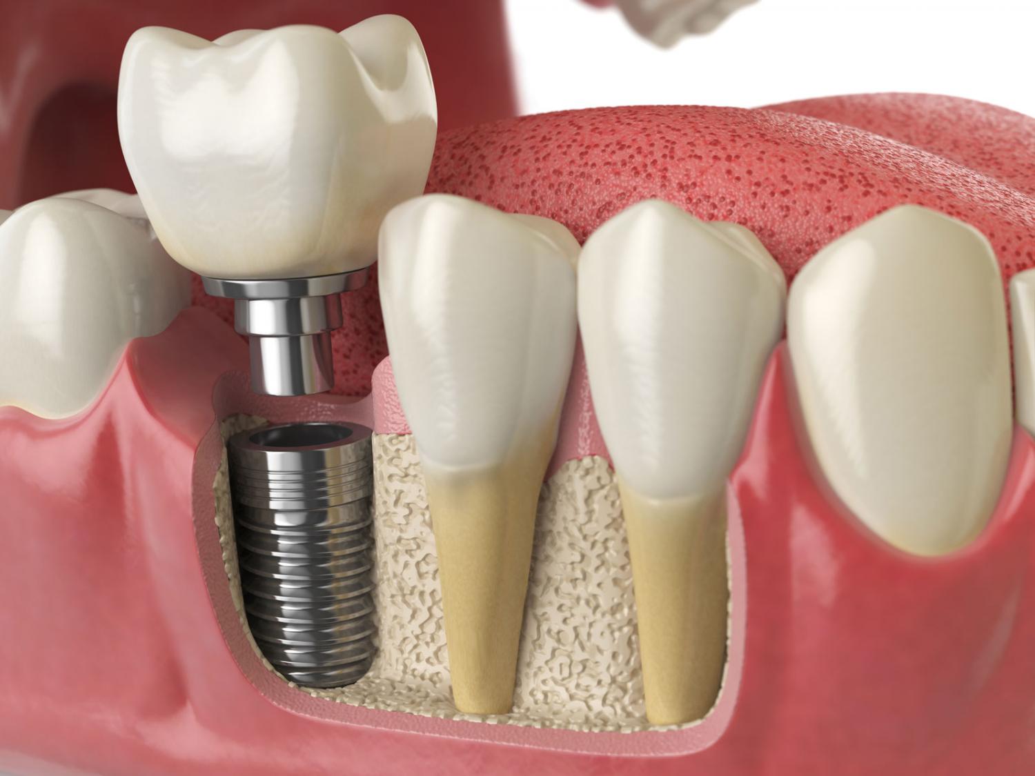  Имплантация зубов: этапы проведения